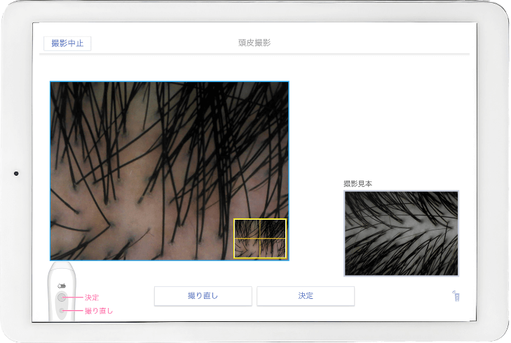 白髪・抜け毛の表示例